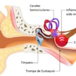 Laberintitis ¿Que es la laberintitis? - Info acúfenos