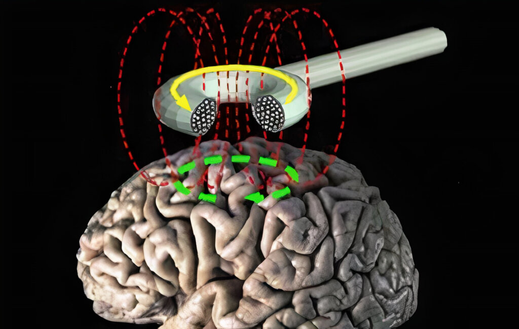 Estimulación magnética transcraneal
