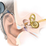 Implante coclear y acúfeno