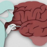 El tinnitus puede ser un síntoma de Aneurisma en el cerebro