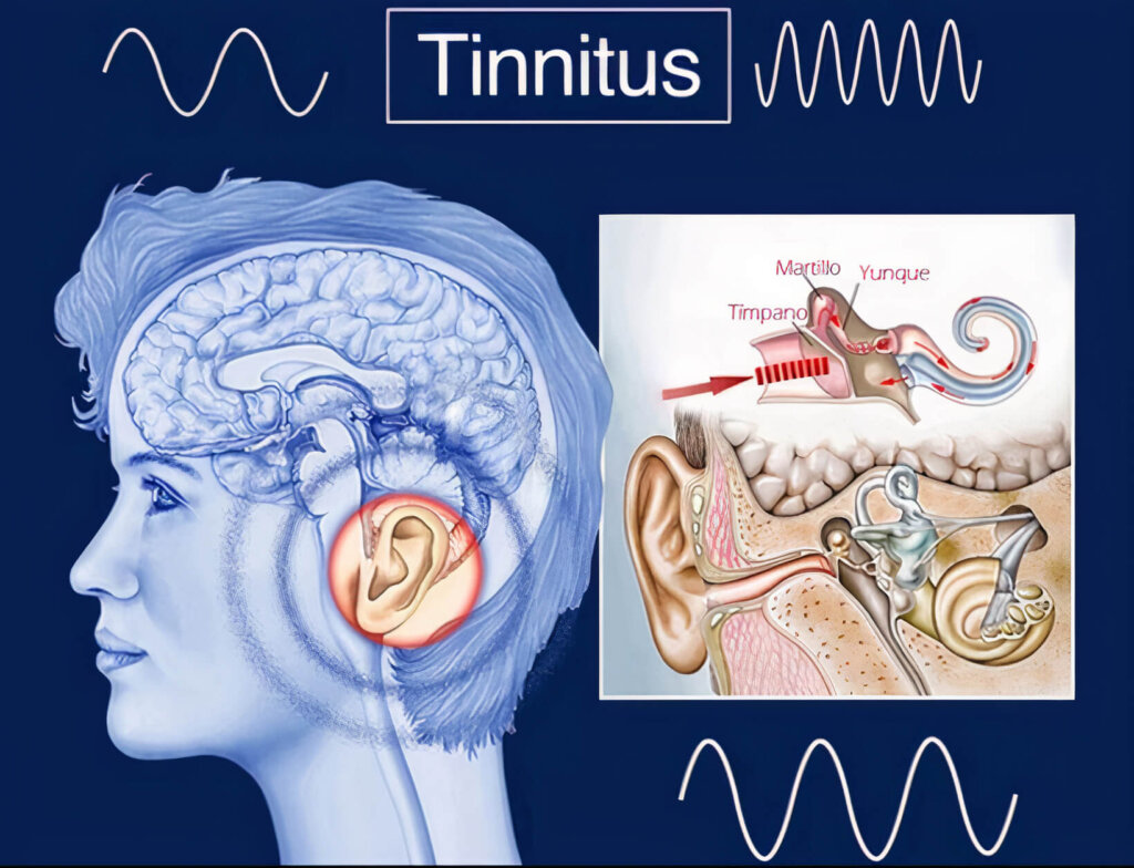 Tinnitus