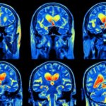 En algunos casos, lo mejor puede ser no tratar el neuroma acústico