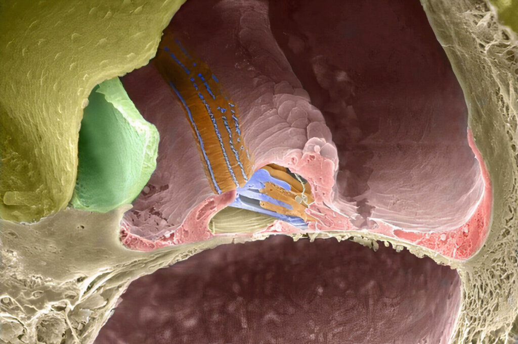 Reclutamiento auditivo