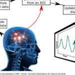 Tratamiento para el tinnitus