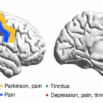 Cerebro tinnitus