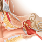 Advanced Bionics anuncia la aprobación de la FDA de HiRes Ultra 3D Cochlear Implant