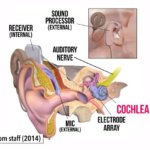 Avances en implantes cocleares: Una esperanza para el tratamiento del tinnitus en personas con pérdi...
