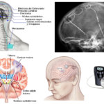 La estimulación cerebral profunda es segura y efectiva en el tratamiento del tinnitus refractario se...