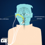 El tinnitus puede tratarse pronto con la ayuda de este dispositivo patentado por la Universidad de M...