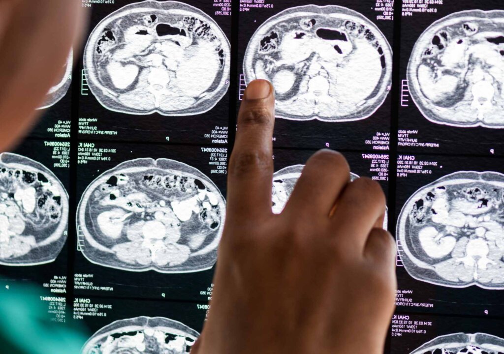 objetivos terapéuticos para tumores cerebrales infantiles