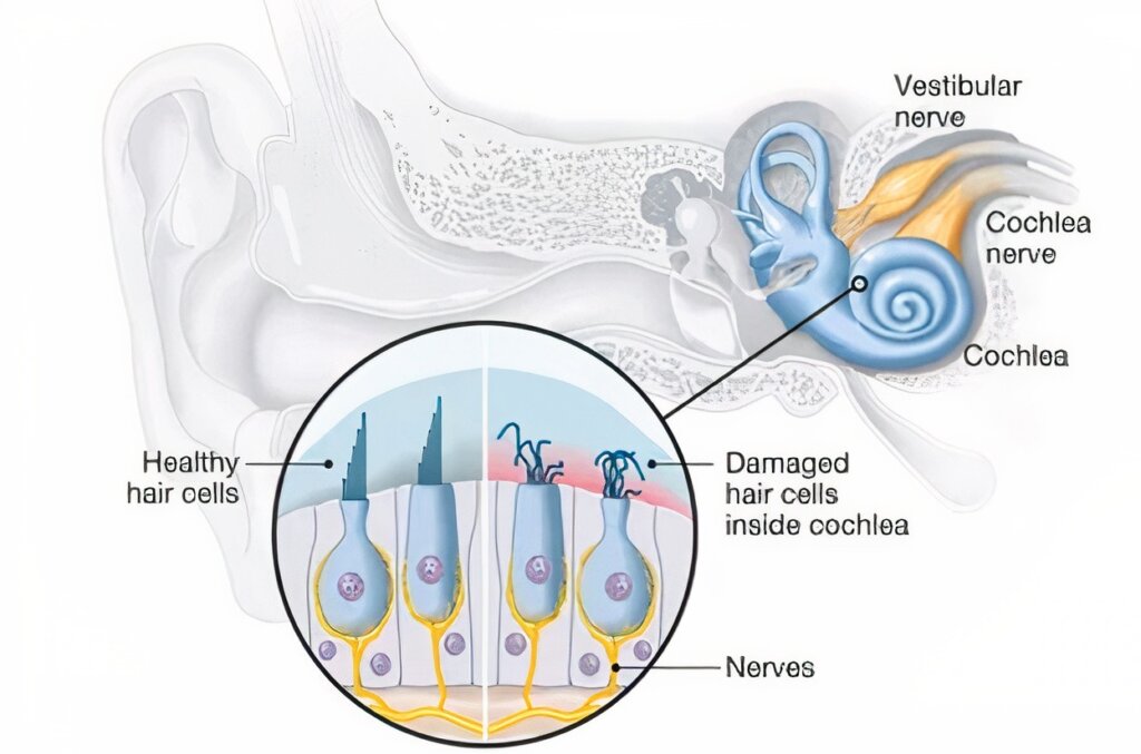 Tinnitus