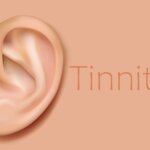 Enfoques para mitigar el tinnitus