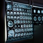 Estudio: El Tinnitus Obliga al Cerebro a Estar en Alerta Constante