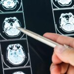 Lo que descubrieron sobre la serotonina podría cambiar el tratamiento del tinnitus